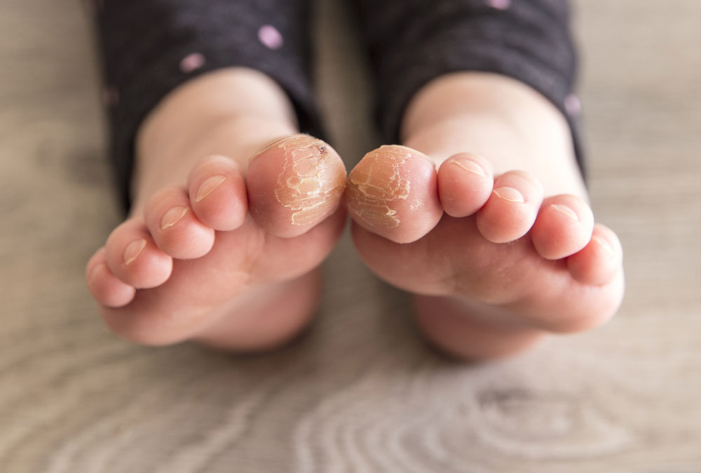 dry skin on toddlers feet